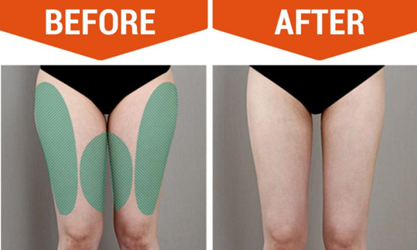What is Thigh Liposuction? What is Thigh Liposuction?
