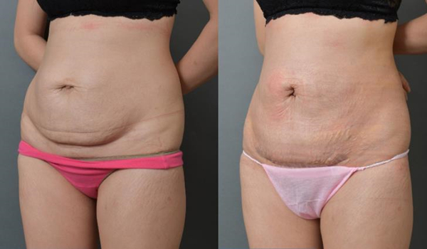 Are tummy tucks worth the money Are tummy tucks worth the money