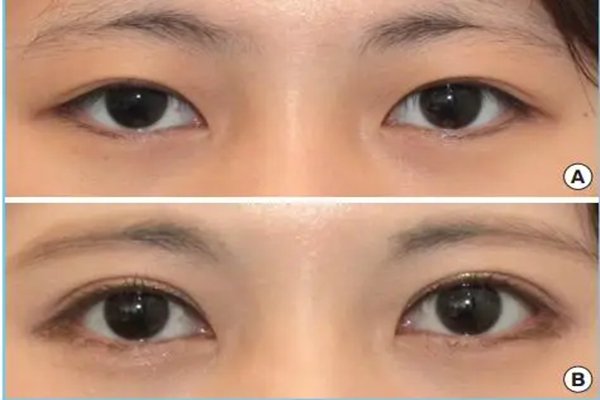 Epicanthoplasty Before and After Epicanthoplasty Before and After
