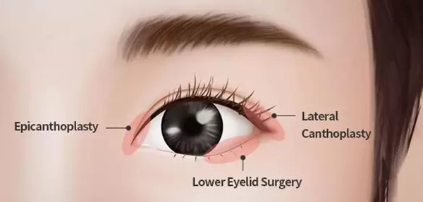 What is Epicanthoplasty What is Epicanthoplasty