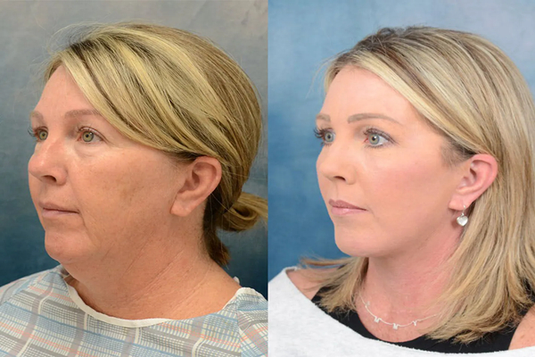 Facelift at Age 60 and beyound Facelift at Age 60 and beyound