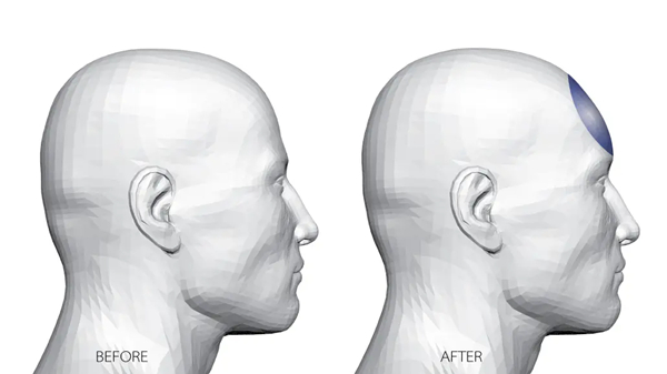 Skull Reshaping Surgery Skull Reshaping Surgery