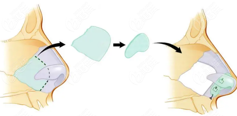 Which is Better for Nose Reconstruction, Japan or South Korea? Which is Better for Nose Reconstruction, Japan or South Korea?