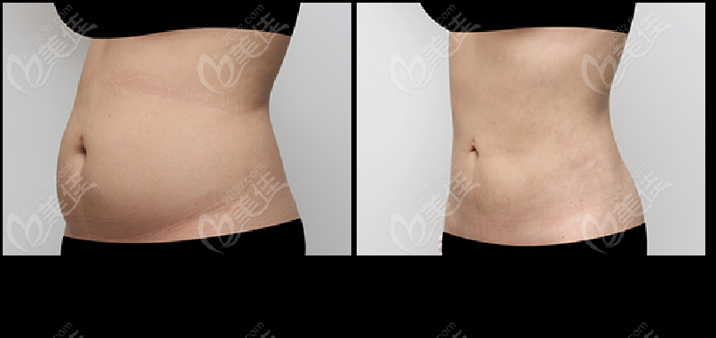 abdominal liposuction abdominal liposuction