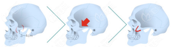 3D Cheekbone Reduction Surgery 3D Cheekbone Reduction Surgery