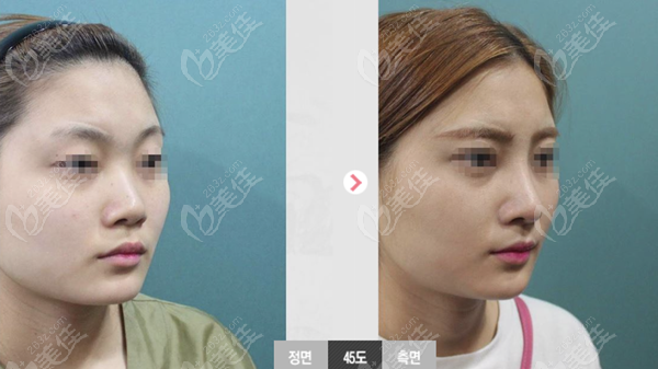 nose job beore&after