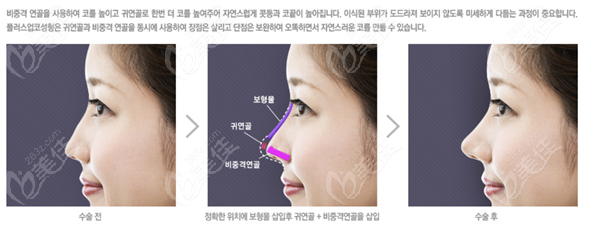 rhinoplasty