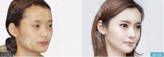 Example of 3D Cheekbone Reduction Surgery Example of 3D Cheekbone Reduction Surgery