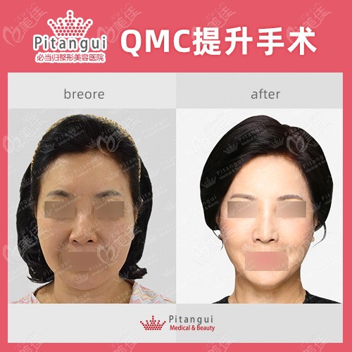 Pitangui Plastic Surgery's Facelift Showcase Pitangui Plastic Surgery's Facelift Showcase