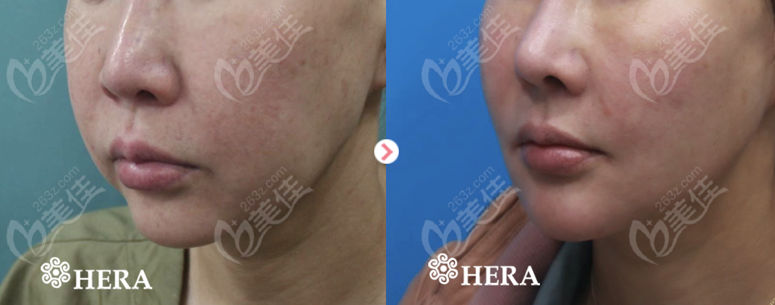 Example of Li Bingwen's 3D Rhinoplasty Procedure