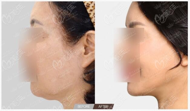 Pitangui Plastic Surgery Facelift Case 2 Pitangui Plastic Surgery Facelift Case 2