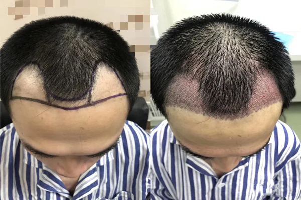 hair transplantation hair transplantation