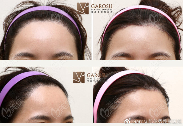 forehead reduction