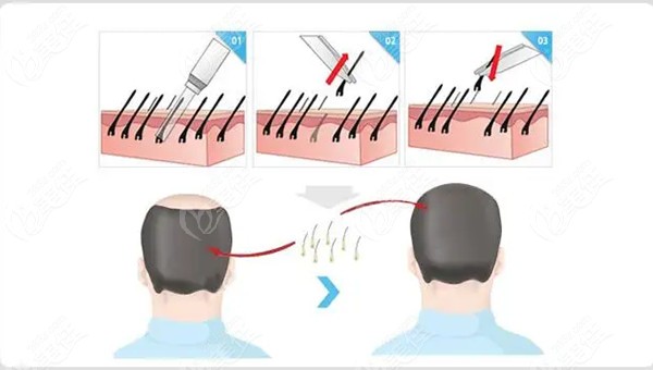 outh Korea's aesthetic hair transplant surpasses that of Turkey. outh Korea's aesthetic hair transplant surpasses that of Turkey.