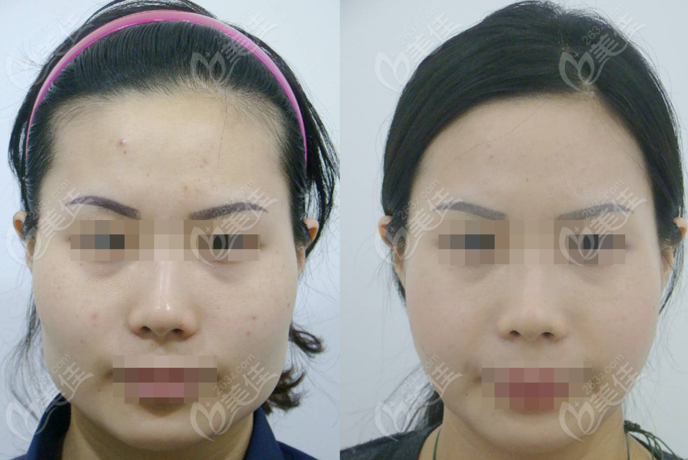 Facial Contouring Facial Contouring