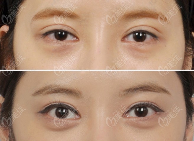 Eyelid Repair Before and After Comparison Eyelid Repair Before and After Comparison