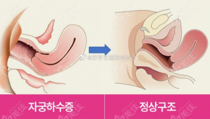 Posterior vaginal wall prolapse repair Posterior vaginal wall prolapse repair