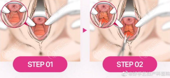 Miss vaginal rejuvenation Miss vaginal rejuvenation