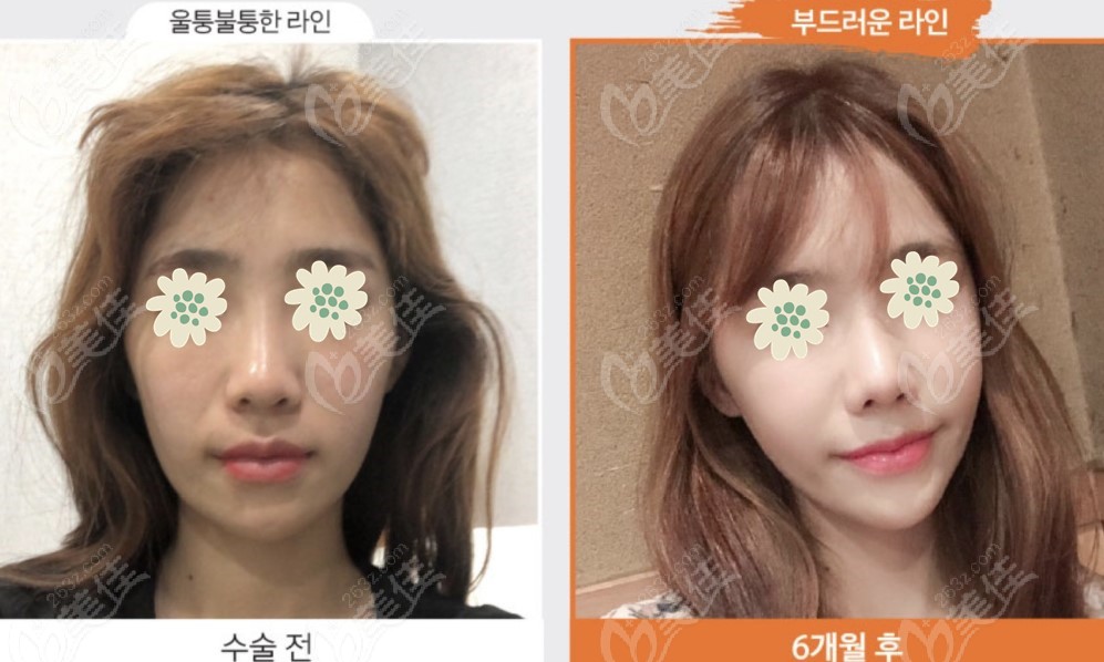 Comparison photos before and after the Korean three-piece contouring surgery▼ Comparison photos before and after the Korean three-piece contouring surgery▼