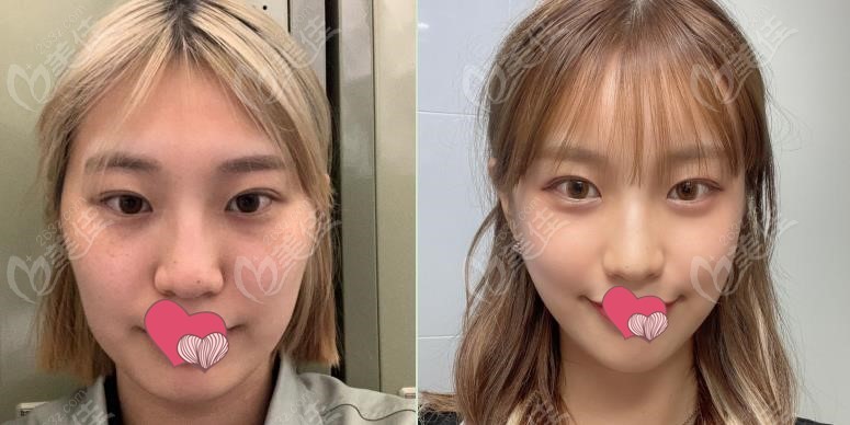 Comparison before and after cheekbone reduction and mandibular angle resection at 1% Plastic Surgery Comparison before and after cheekbone reduction and mandibular angle resection at 1% Plastic Surgery