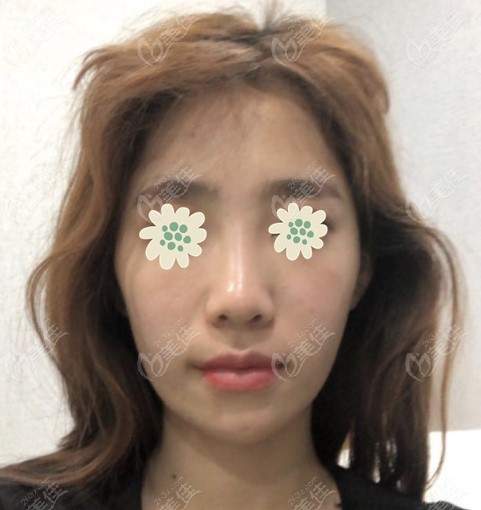 My real experience of undergoing the three-piece contouring surgery in Korea My real experience of undergoing the three-piece contouring surgery in Korea