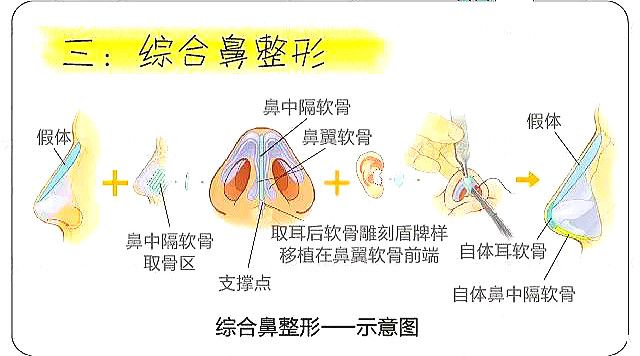 Comprehensive nose reshaping Comprehensive nose reshaping
