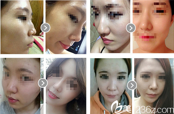 nose augmentation nose augmentation