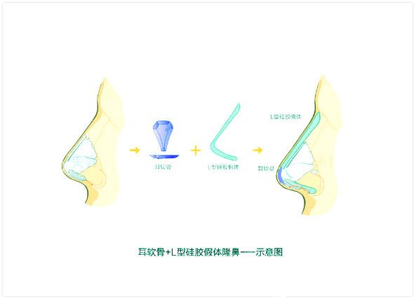 L-shaped implant with ear cartilage nose augmentation L-shaped implant with ear cartilage nose augmentation