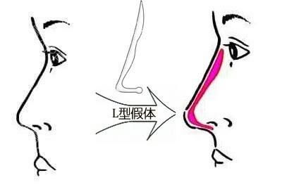 L-shaped implant nose augmentation L-shaped implant nose augmentation