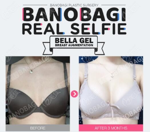 breast augmentation breast augmentation