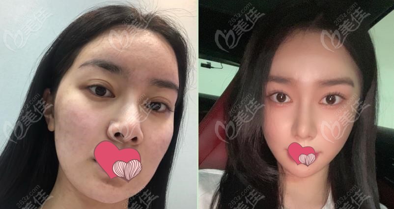 comparison photos of zygoma reduction comparison photos of zygoma reduction