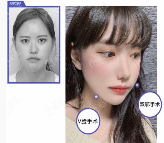 Double Jaw Surgery Double Jaw Surgery