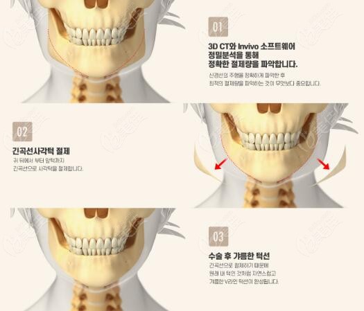 Long curve bone trimming Long curve bone trimming