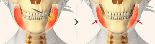 reduction of masseter muscle reduction of masseter muscle