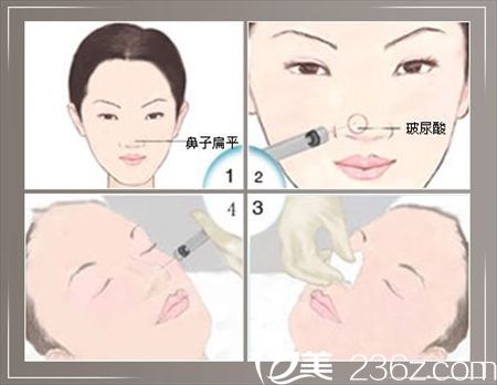 Hyaluronic Acid Injections Hyaluronic Acid Injections