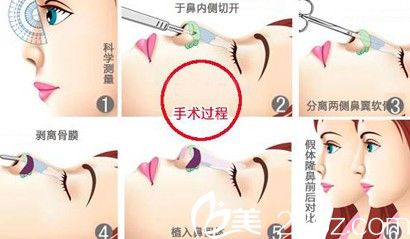 Silicone Implants Silicone Implants