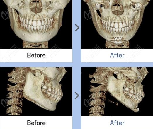 jaw angle contouring surgery jaw angle contouring surgery
