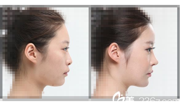 rhinoplasty rhinoplasty