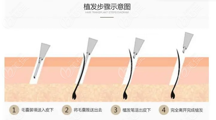 How is the Hair Transplantation Technology in Thailand? How is the Hair Transplantation Technology in Thailand?