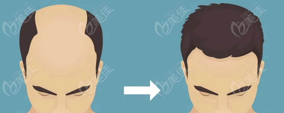 hair transplantation hair transplantation