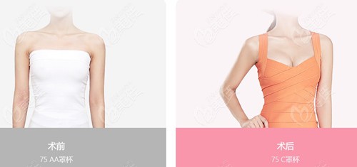 breast augmentation breast augmentation