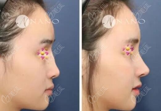 extensive experience in nose surgery extensive experience in nose surgery