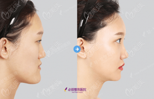 double jaw surgery double jaw surgery