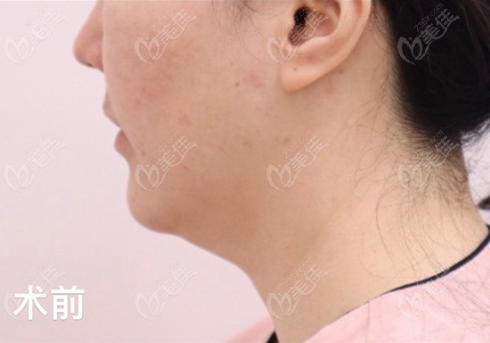 Face Liposuction Example at LIBAN Clinic: Fast Recovery, No Sagging Face Liposuction Example at LIBAN Clinic: Fast Recovery, No Sagging