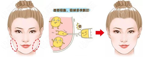 principle of face liposuction principle of face liposuction