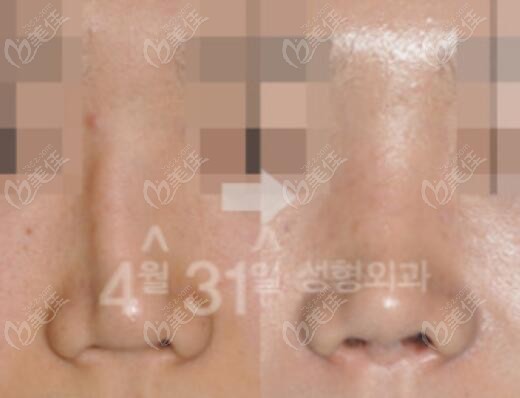 nose augmentation nose augmentation