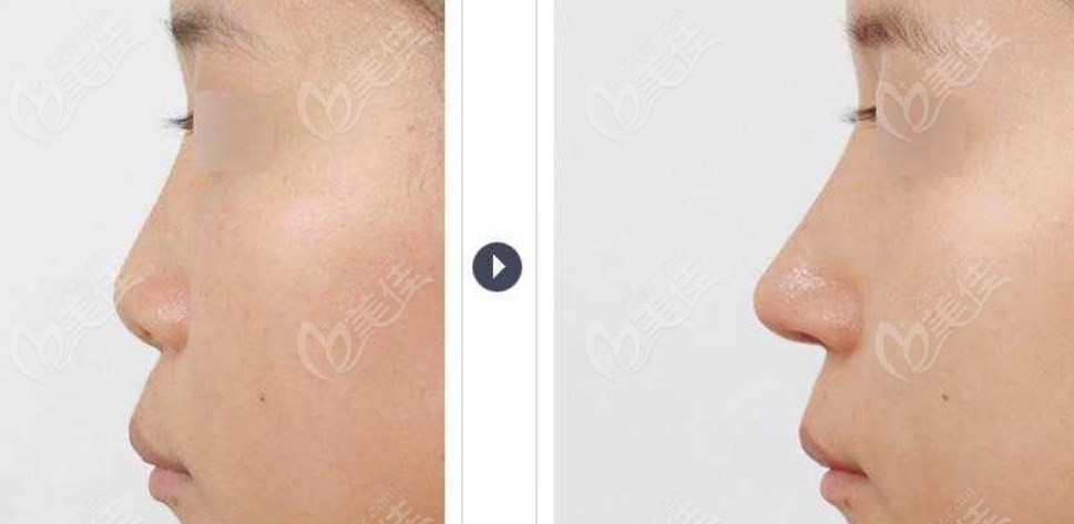 Nasal Repair Nasal Repair