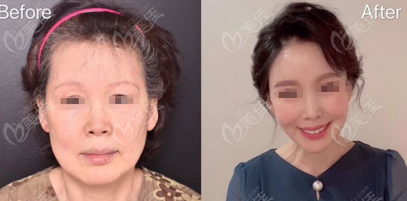 Examples of facelift surgery Examples of facelift surgery