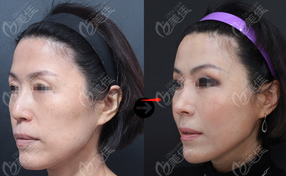 The post-surgery effects The post-surgery effects