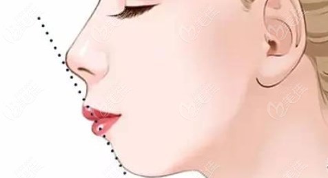 protruding lips surgery protruding lips surgery
